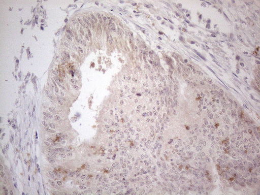ZNF200 Antibody - Immunohistochemical staining of paraffin-embedded Adenocarcinoma of Human colon tissue using anti-ZNF200 mouse monoclonal antibody. (Heat-induced epitope retrieval by 1mM EDTA in 10mM Tris buffer. (pH8.5) at 120°C for 3 min. (1:150)