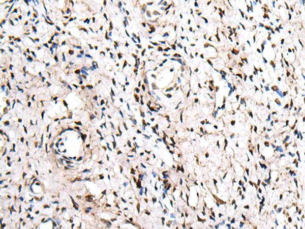 ZNF207 Antibody - Immunohistochemistry of paraffin-embedded Human cervical cancer tissue  using ZNF207 Polyclonal Antibody at dilution of 1:30(×200)