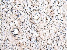 ZNF207 Antibody - Immunohistochemistry of paraffin-embedded Human cervical cancer tissue  using ZNF207 Polyclonal Antibody at dilution of 1:30(×200)