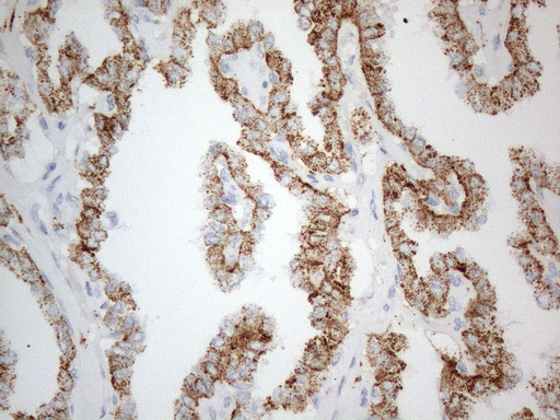 ZNF217 Antibody - Immunohistochemical staining of paraffin-embedded Carcinoma of Human thyroid tissue using anti-ZNF217 mouse monoclonal antibody. (Heat-induced epitope retrieval by 1mM EDTA in 10mM Tris buffer. (pH8.5) at 120°C for 3 min. (1:150)