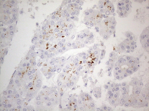 ZNF217 Antibody - Immunohistochemical staining of paraffin-embedded Carcinoma of Human liver tissue using anti-ZNF217 mouse monoclonal antibody. (Heat-induced epitope retrieval by 1mM EDTA in 10mM Tris buffer. (pH8.5) at 120°C for 3 min. (1:150)