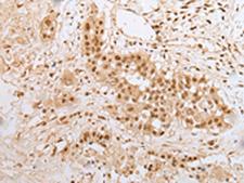 ZNF22 Antibody - Immunohistochemistry of paraffin-embedded Human colorectal cancer tissue  using ZNF22 Polyclonal Antibody at dilution of 1:25(×200)