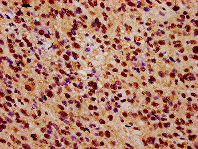 ZNF224 Antibody - Immunohistochemistry Dilution at 1:500 and staining in paraffin-embedded human glioma cancer performed on a Leica BondTM system. After dewaxing and hydration, antigen retrieval was mediated by high pressure in a citrate buffer (pH 6.0). Section was blocked with 10% normal Goat serum 30min at RT. Then primary antibody (1% BSA) was incubated at 4°C overnight. The primary is detected by a biotinylated Secondary antibody and visualized using an HRP conjugated SP system.