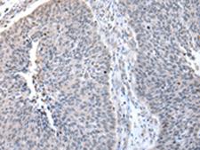 ZNF23 Antibody - Immunohistochemistry of paraffin-embedded Human lung cancer tissue  using ZNF23 Polyclonal Antibody at dilution of 1:50(×200)