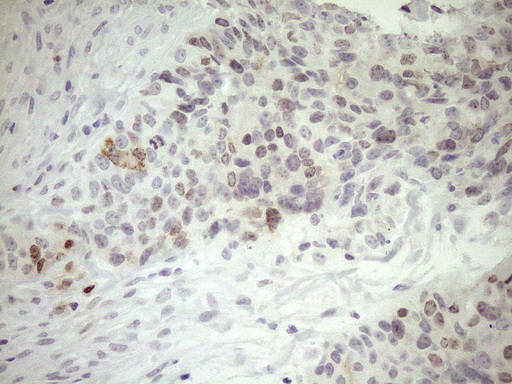 ZNF230 Antibody - Immunohistochemical staining of paraffin-embedded Adenocarcinoma of Human endometrium tissue using anti-ZNF230 mouse monoclonal antibody. (Heat-induced epitope retrieval by 1mM EDTA in 10mM Tris buffer. (pH8.5) at 120°C for 3 min. (1:150)