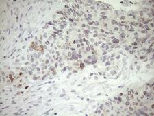 ZNF230 Antibody - Immunohistochemical staining of paraffin-embedded Adenocarcinoma of Human endometrium tissue using anti-ZNF230 mouse monoclonal antibody. (Heat-induced epitope retrieval by 1mM EDTA in 10mM Tris buffer. (pH8.5) at 120°C for 3 min. (1:150)