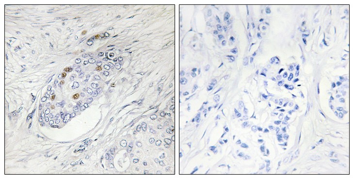 ZNF232 Antibody - Immunohistochemistry analysis of paraffin-embedded human breast carcinoma, using ZNF232 Antibody. The picture on the right is blocked with the synthesized peptide.