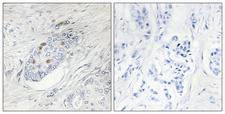 ZNF232 Antibody - Immunohistochemistry analysis of paraffin-embedded human breast carcinoma, using ZNF232 Antibody. The picture on the right is blocked with the synthesized peptide.