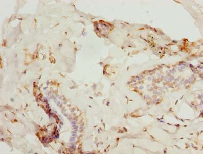 ZNF232 Antibody - Immunohistochemistry of paraffin-embedded human breast cancer using antibody at dilution of 1:100.