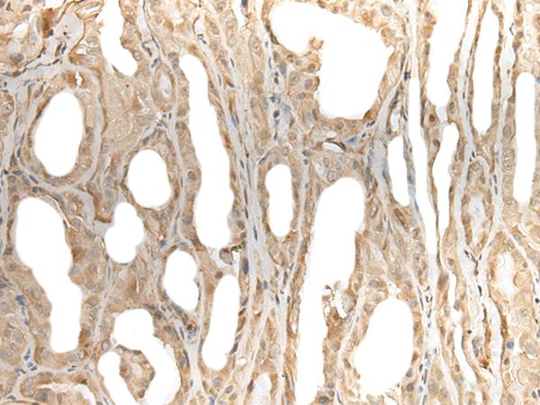 ZNF238 Antibody - Immunohistochemistry of paraffin-embedded Human thyroid cancer tissue  using ZBTB18 Polyclonal Antibody at dilution of 1:50(×200)