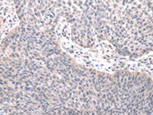 ZNF239 Antibody - Immunohistochemistry of paraffin-embedded Human lung cancer tissue  using ZNF239 Polyclonal Antibody at dilution of 1:25(×200)