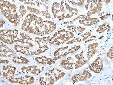 ZNF248 Antibody - Immunohistochemistry of paraffin-embedded Human esophagus cancer tissue  using ZNF248 Polyclonal Antibody at dilution of 1:25(×200)