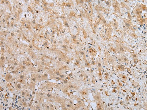 ZNF248 Antibody - Immunohistochemistry of paraffin-embedded Human liver cancer tissue  using ZNF248 Polyclonal Antibody at dilution of 1:25(×200)