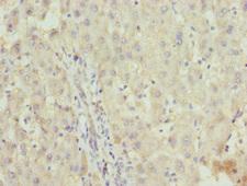 ZNF253 Antibody - Immunohistochemistry of paraffin-embedded human liver cancer at dilution 1:100