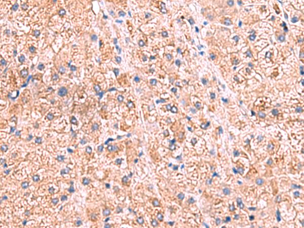 ZNF256 Antibody - Immunohistochemistry of paraffin-embedded Human liver cancer tissue  using ZNF256 Polyclonal Antibody at dilution of 1:70(×200)