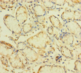 ZNF26 Antibody - Immunohistochemistry of paraffin-embedded human gastric cancer using ZNF26 Antibody at dilution of 1:100