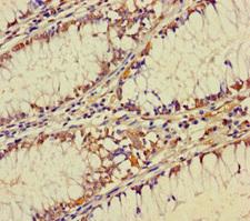 ZNF260 Antibody - Immunohistochemistry of paraffin-embedded human colon cancer using ZNF260 Antibody at dilution of 1:100