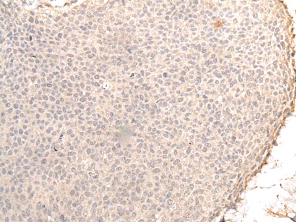 ZNF263 Antibody - Immunohistochemistry of paraffin-embedded Human cervical cancer tissue  using ZNF263 Polyclonal Antibody at dilution of 1:30(×200)