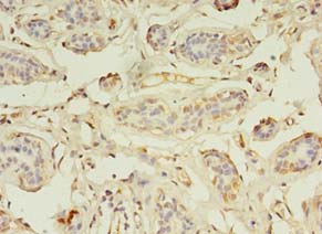 ZNF266 Antibody - Immunohistochemistry of paraffin-embedded human breast cancer using antibody at 1:100 dilution.