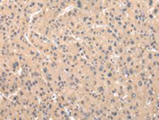 ZNF268 Antibody - Immunohistochemistry of paraffin-embedded Human liver cancer tissue  using ZNF268 Polyclonal Antibody at dilution of 1:50(×200)