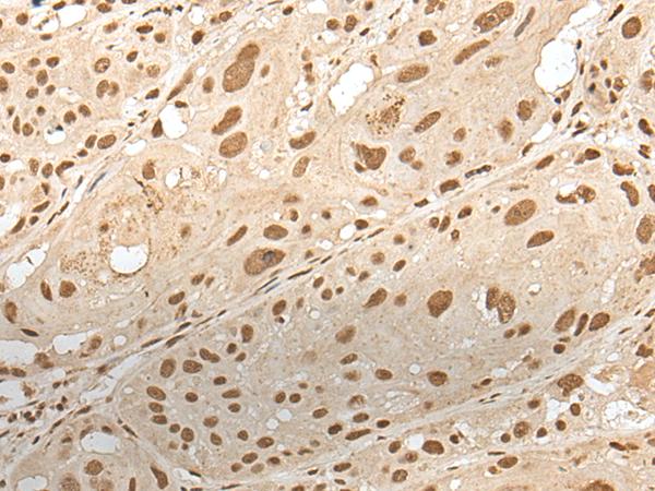 ZNF274 Antibody - Immunohistochemistry of paraffin-embedded Human esophagus cancer tissue  using ZNF274 Polyclonal Antibody at dilution of 1:35(×200)