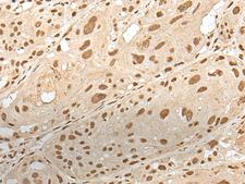 ZNF274 Antibody - Immunohistochemistry of paraffin-embedded Human esophagus cancer tissue  using ZNF274 Polyclonal Antibody at dilution of 1:35(×200)