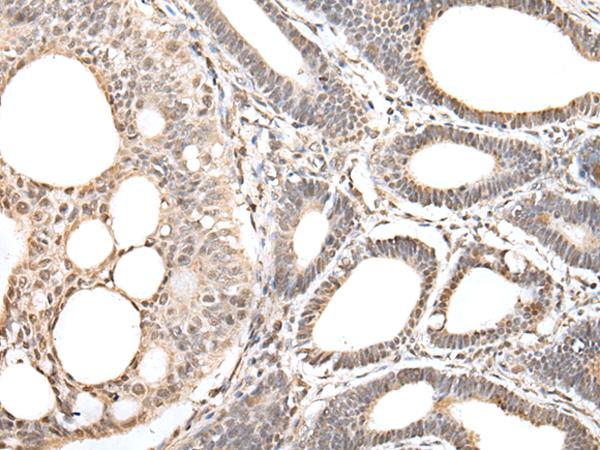 ZNF281 / Zfp281 Antibody - Immunohistochemistry of paraffin-embedded Human gastric cancer tissue  using ZNF281 Polyclonal Antibody at dilution of 1:30(×200)