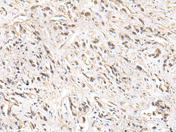 ZNF281 / Zfp281 Antibody - Immunohistochemistry of paraffin-embedded Human prost ate cancer tissue  using ZNF281 Polyclonal Antibody at dilution of 1:30(×200)