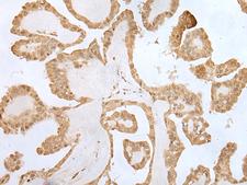 ZNF281 / Zfp281 Antibody - Immunohistochemistry of paraffin-embedded Human thyroid cancer tissue  using ZNF281 Polyclonal Antibody at dilution of 1:70(×200)