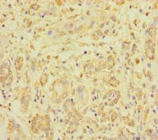 ZNF287 Antibody - Immunohistochemistry of paraffin-embedded human pancreatic cancer using ZNF287 Antibody at dilution of 1:100