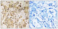 ZNF295 Antibody - Immunohistochemistry analysis of paraffin-embedded human breast carcinoma tissue, using ZNF295 Antibody. The picture on the right is blocked with the synthesized peptide.