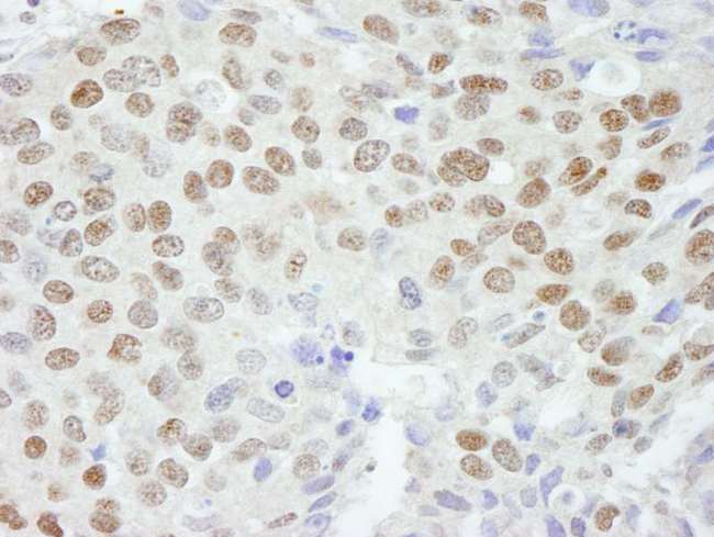 ZNF295 Antibody - Detection of Human ZNF295 by Immunohistochemistry. Sample: FFPE section of human breast carcinoma. Antibody: Affinity purified rabbit anti-ZNF295 used at a dilution of 1:250.