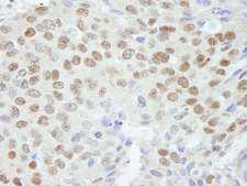 ZNF295 Antibody - Detection of Human ZNF295 by Immunohistochemistry. Sample: FFPE section of human breast carcinoma. Antibody: Affinity purified rabbit anti-ZNF295 used at a dilution of 1:250.