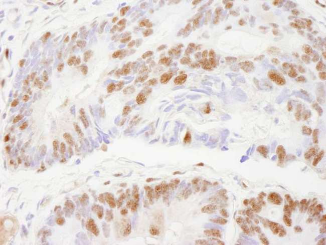 ZNF295 Antibody - Detection of Human ZNF295 by Immunohistochemistry. Sample: FFPE section of human colon carcinoma. Antibody: Affinity purified rabbit anti-ZNF295 used at a dilution of 1:250.