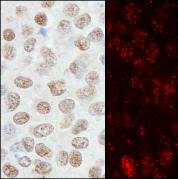 ZNF295 Antibody - Detection of Human ZNF295 by Immunohistochemistry and Immunofluorescence. Sample: FFPE sections of human breast carcinoma. Antibody: Affinity purified rabbit anti-ZNF295 used at a dilution of 1:1000 (1 ug/ml) and 1:400 (2.5 ug/ml). Detection: DAB and Red-fluorescent Goat anti-Rabbit IgG-heavy and light chain, cross-adsorbed Antibody DyLight 594 Conjugated used at a dilution of 1:100.