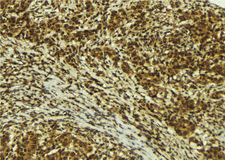 ZNF295 Antibody - 1:100 staining human breast carcinoma tissue by IHC-P. The sample was formaldehyde fixed and a heat mediated antigen retrieval step in citrate buffer was performed. The sample was then blocked and incubated with the antibody for 1.5 hours at 22°C. An HRP conjugated goat anti-rabbit antibody was used as the secondary.
