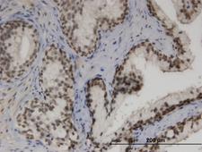 ZNF3 Antibody - Immunoperoxidase of monoclonal antibody to ZNF3 on formalin-fixed paraffin-embedded human prostate. [antibody concentration 3 ug/ml]