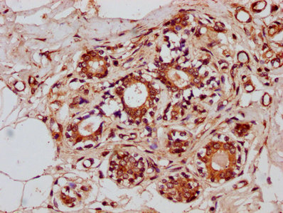 ZNF3 Antibody - Immunohistochemistry Dilution at 1:300 and staining in paraffin-embedded human breast cancer performed on a Leica BondTM system. After dewaxing and hydration, antigen retrieval was mediated by high pressure in a citrate buffer (pH 6.0). Section was blocked with 10% normal Goat serum 30min at RT. Then primary antibody (1% BSA) was incubated at 4°C overnight. The primary is detected by a biotinylated Secondary antibody and visualized using an HRP conjugated SP system.