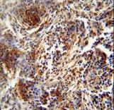 ZNF30 Antibody - ZNF30 antibody immunohistochemistry of formalin-fixed and paraffin-embedded human lung carcinoma followed by peroxidase-conjugated secondary antibody and DAB staining.
