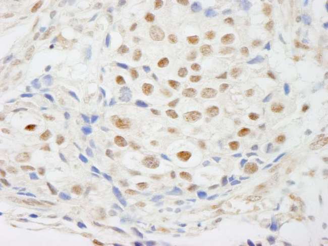 ZNF318 Antibody - Detection of Human ZNF318/TZF by Immunohistochemistry. Sample: FFPE section of human breast carcinoma. Antibody: Affinity purified rabbit anti-ZNF318/TZF used at a dilution of 1:250.