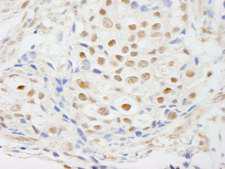 ZNF318 Antibody - Detection of Human ZNF318/TZF by Immunohistochemistry. Sample: FFPE section of human breast carcinoma. Antibody: Affinity purified rabbit anti-ZNF318/TZF used at a dilution of 1:250.