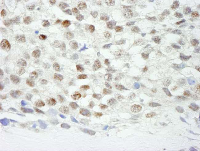 ZNF318 Antibody - Detection of Human ZNF318/TZF by Immunohistochemistry. Sample: FFPE section of human seminoma. Antibody: Affinity purified rabbit anti-ZNF318/TZF used at a dilution of 1:500.