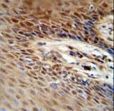 ZNF324 / ZF5128 Antibody - ZNF324B antibody immunohistochemistry of formalin-fixed and paraffin-embedded human skin carcinoma followed by peroxidase-conjugated secondary antibody and DAB staining.