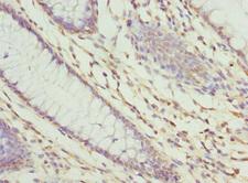 ZNF324 / ZF5128 Antibody - Immunohistochemistry of paraffin-embedded human colon cancer at dilution 1:100