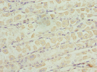 ZNF324 / ZF5128 Antibody - Immunohistochemistry of paraffin-embedded human gastric cancer at dilution 1:100