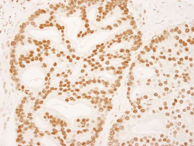ZNF326 / Zfp326 Antibody - Detection of Human ZNF326 by Immunohistochemistry. Sample: FFPE section of human prostate carcinoma. Antibody: Affinity purified rabbit anti-ZNF326 used at a dilution of 1:250.