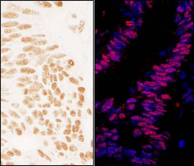 ZNF326 / Zfp326 Antibody - Detection of Human ZNF326 by Immunohistochemistry and Immunofluorescence. Sample: FFPE sections of human ovarian carcinoma (left) and colon carcinoma (right). Antibody: Affinity purified rabbit anti-ZNF326 used at a dilution of 1:1000 (0.2 ug/ml) and 1:400 (0.5 ug/ml). Detection: DAB and Red-fluorescent Goat anti-Rabbit IgG-heavy and light chain, cross-adsorbed Antibody DyLight 594 Conjugated used at a dilution of 1:100.