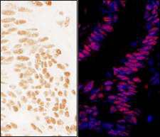 ZNF326 / Zfp326 Antibody - Detection of Human ZNF326 by Immunohistochemistry and Immunofluorescence. Sample: FFPE sections of human ovarian carcinoma (left) and colon carcinoma (right). Antibody: Affinity purified rabbit anti-ZNF326 used at a dilution of 1:1000 (0.2 ug/ml) and 1:400 (0.5 ug/ml). Detection: DAB and Red-fluorescent Goat anti-Rabbit IgG-heavy and light chain, cross-adsorbed Antibody DyLight 594 Conjugated used at a dilution of 1:100.