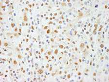 ZNF335 / NIF1 Antibody - Detection of Human NIF1 by Immunohistochemistry. Sample: FFPE section of human Hodgkin's lymphoma. Antibody: Affinity purified rabbit anti-NIF1 used at a dilution of 1:200 (1 ug/ml). Detection: DAB.