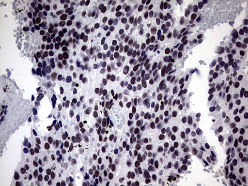 ZNF34 Antibody - IHC of paraffin-embedded Adenocarcinoma of Human breast tissue using anti-ZNF34 mouse monoclonal antibody. (Heat-induced epitope retrieval by 1 mM EDTA in 10mM Tris, pH8.5, 120°C for 3min).